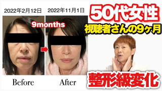 50代女性視聴者さんの9ヶ月 整形級変化
